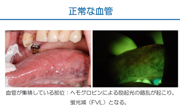 VELscope 正常な血管.jpg